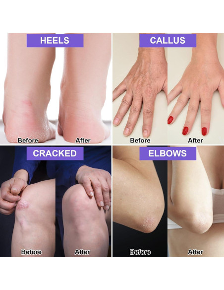 2 Paquetes Crema de Urea 42% y Ácido Salicílico 2% para Pies