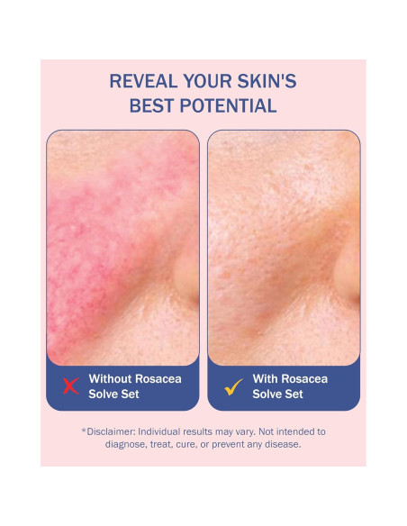 Conjunto Cuidado Piel Rosácea e70 - Limpiador, Crema y Suero