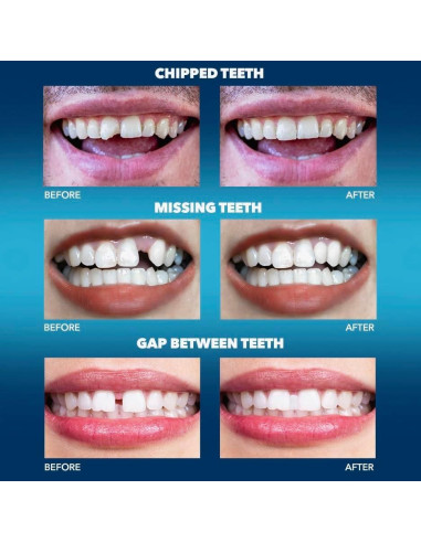 Imako Diente Temporal Plástico Color Natural - Ajuste Rápido